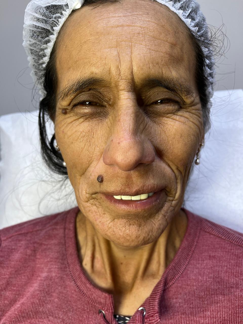 Antes del tratamiento — resultado real 10, Klass Salón & Spa