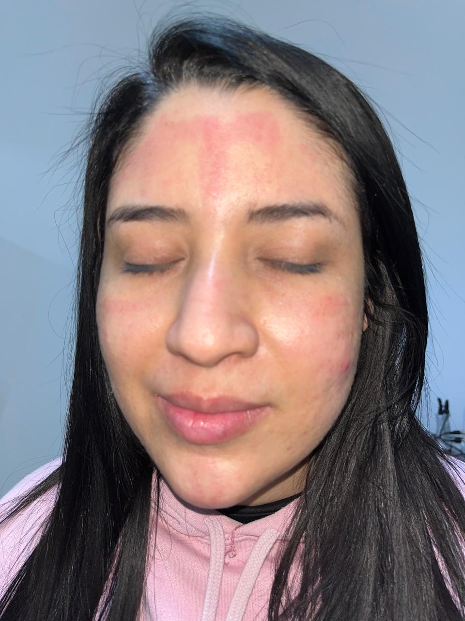 Antes del tratamiento — resultado real 6, Klass Salón & Spa